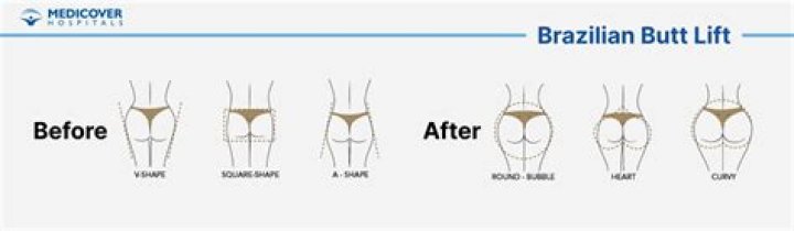 Brazilian butt lift deaths spark warning from Australasian plastic surgeons society