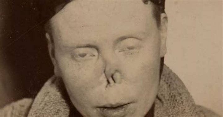 The surprisingly heartwarming story of the London 'syphilis club' for men and women who 'had no noses'